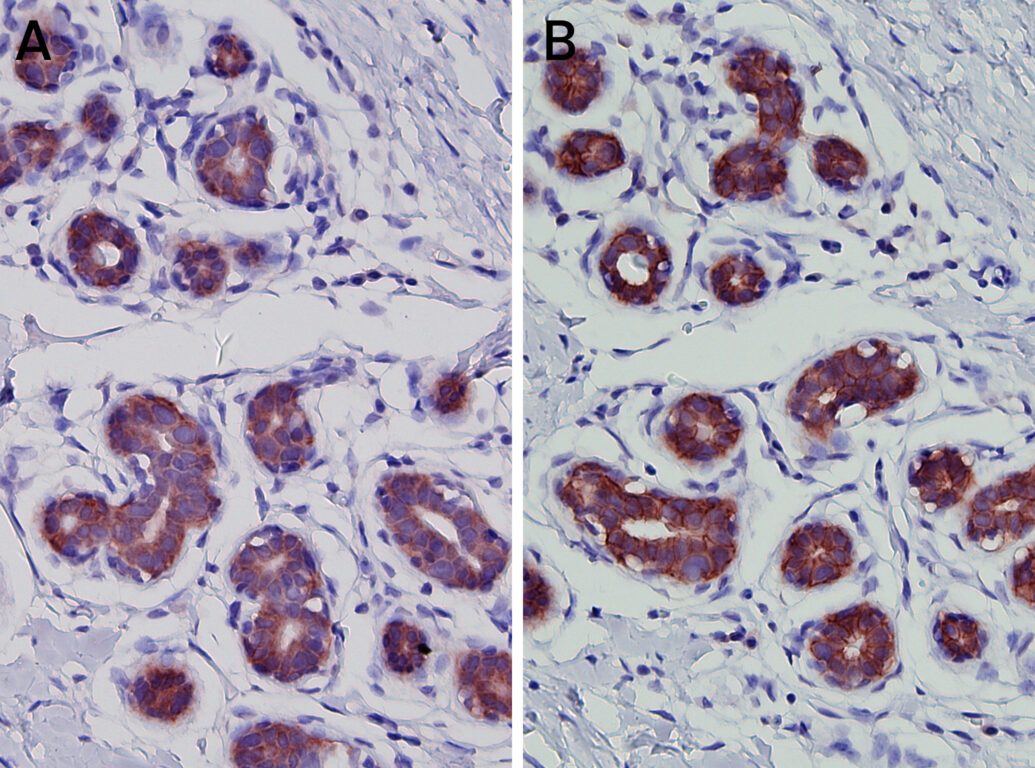 Negative HER2 in breast tissue detected with IHC, unspecific signals