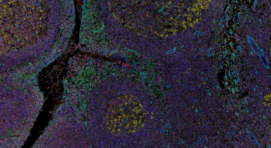 Navinci highlights a new preprint by Associate Professor Charlotte Stadler and collaborators, using in situ PLA to detect PD-1/PD-L1 interactions linked to immunotherapy response.